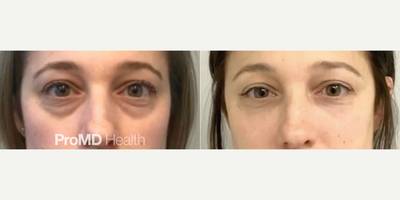 Woman treated with Hyaluronidase, Sculptra - Woman treated with Hyaluronidase, Sculptra