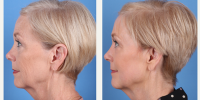 64 year old woman treated with Phenol Peel to full face - Dr.Sukkar performed a Phenol Peel to this 64 year old patient. Photos taken at 3 months post op.(281) 990-8487 | 14018 Aesthetic Circle Houston, TX 77062 | www.drsukkar.com
