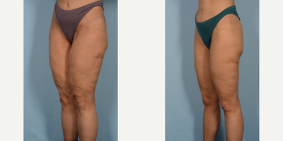 45-54 year old woman treated with Thigh Lift - Thigh Lift