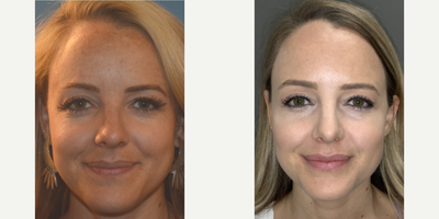 25-34 year old woman treated with Venus Viva - This patient had a combination of venus viva and chemical peel treatments along with at home medical grade skin care. These pictures are two years apart with a big improvement in sun damage and overall radiance of the skin.