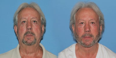 Man treated with Deep Plane Facelift - Man treated with Deep Plane Facelift