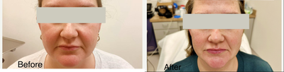 35-44 year old woman treated with Forma, Skin Tightening, Nonsurgical Facelift - Beautiful facial contouring results post 3 treatments of Forma, non invasive facial contouring. The chin is more contoured as well as softening of the nasolabial fold and tightened mid cheek.