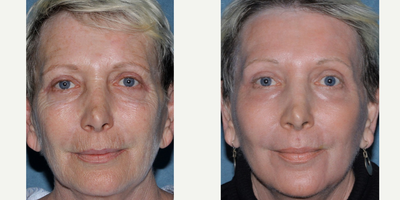 63 year old woman treated with Fraxel Repair, Co2 and erbium lasers - Dr. Groff treated this patient only one time with a combination of the Fraxel Repair, Lumenis Ultrapulse Encore CO2 and the Sciton Erbium laser (all in one single treatment session).  This patient has no make up on her skin and you can see the dramatic reduction in wrinkles and tightening of the skin.