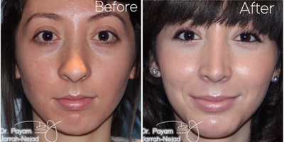 Woman treated with Chin Surgery - Woman treated with Chin Surgery using implant as well as Rhinoplasty