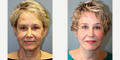 68 year old woman treated with Lifestyle Lift - This 68 year old patient underwent a LiteLift, Lifestyle Lift, along with upper and lower eyelid surgery, blue peel, facial fat transfer and platysmaplasty. Through a hairline incision hidden within the ear, using local anesthesia,reduced the signs of aging around the jaw, neck, eyes, and lower face. He was also able to add volume to her face using her own fat for a natural and refreshed appearance.