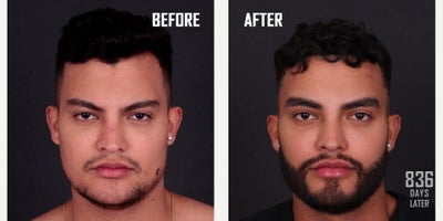 25-34 year old man treated with Beard Transplant - Bears transplant with FUE technique