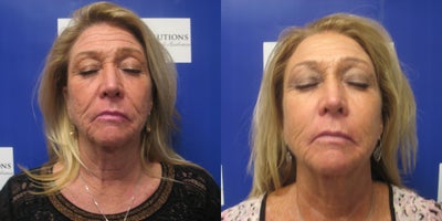65-74 year old woman treated with Sylfirm X - Before and after 3 Sylfirm X treatments with added exosomal therapy. Notice the softening and reductions in deep wrinkles.