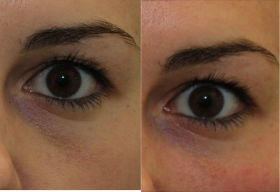 25-34 year old woman treated with Restylane for under-eye dark circles - Restylane in tear trough and cheek with cannula to reduce under-eye shadows and dark circles