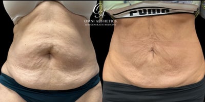 55-64 year old woman treated with Vaser Liposuction, Smart Lipo, Laser Liposuction - Check out our lovely patient who came back 2 years post op to show off her amazing liposuction results!