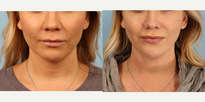 35-44 year old woman treated with Renuvion Powered by Jplasma - Chin area treated with Renuvionpowered by Jplasmafor dermal tightening