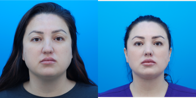 35-44 year old woman treated with Microdermabrasion - Patient is 3 months from open rhinoplasty, buccal fat removal, and deep neck lift without ear incisions. She has also had lip filler and microneedling