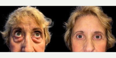 Woman treated with Eyelid Surgery - Woman treated with Eyelid Surgery