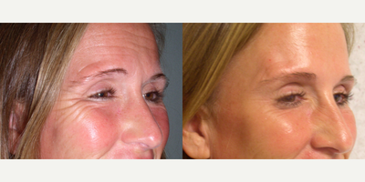 25-34 year old woman treated with Botox - This patient softened her crow's feet with Botox