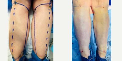 45-54 year old woman treated with Liposculpture - Immediate Lipedema post op results: Circumferential 360 liposuction of the entire calf/ankle cosmetic unit. 5.0 liters removed to achieve maximal cosmetic result and disease treatment. By treating the entire cosmetic unit circumferentially this patient only needs one surgery on the area.