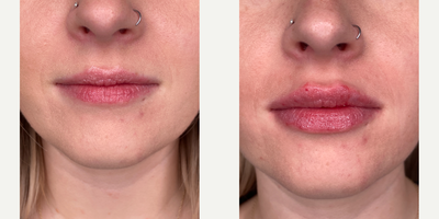 25-34 year old woman treated with Lip Fillers, Revanesse - patient treated with 1 syringe of revanesse lips