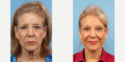 64 year old woman treated with Brow Lift - A 64 year-old woman before and after Cheek and Neck Lift w/Anterior Platysmaplasty, Quad Blepharoplasty, and Endoscopic Brow Lift by Andrew T. Lyos M.D., FACS.