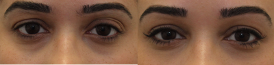 Upper blepharoplasty - Upper blepharoplasty with fat grafting to sub-brows performed to improve eyelid asymmetry