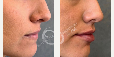 Woman treated with Lip Augmentation - Woman treated with Lip Augmentation using Juvederm