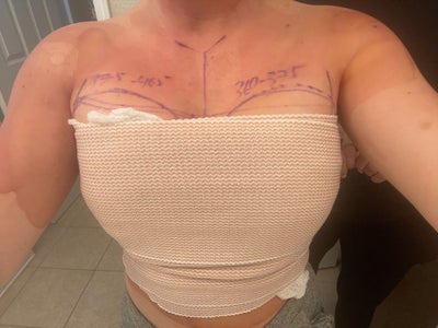 Breast Augmentation Sacramento