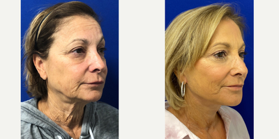 66 year old woman treated with TCA Peel - 66 year old woman treated with Facelift and TCA Peel