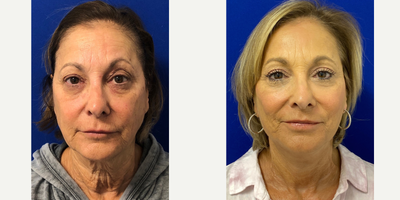 66 year old woman treated with TCA Peel - 66 year old woman treated with Facelift and TCA Peel