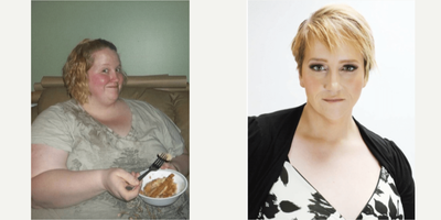 35-44 year old woman treated with Gastric Balloon - 5 years after gastric ballon