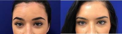 18-24 year old woman treated with Dysport - 24 year old patient wanted to address the fine lines beginning to form on her forehead, crows feet and glabella lines. I treated her with Dysport in those areas. Treating the fine lines at an early age will prevent the lines from further deepening. Here she is 2 weeks post injections, very happy with her results.