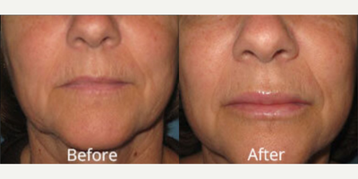 Woman treated with Lip Implants - Woman treated with Lip Implants