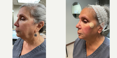 65-74 year old woman treated with NovaThreads - Immediate results with NovaThreads