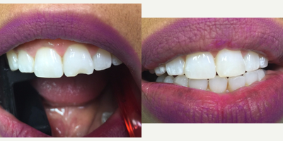 18-24 year old woman treated with Dental Bonding - Before Photo:  Patient suffered a chipped front tooth.  She wanted to fix it in a way that did not look fake.  She did not want to change anything about her other teeth.
After Photo:  Dr. Sarah Thompson repaired patient's tooth with perfectly matched color and shape.  This procedure was done in only one appointment and patient spent a total of 30 minutes in the dental chair.  Bonding is a great alternative to an expensive veneer or crown, but it is not nearly as durable as a porcelain veneer or crown, so if the patient is not careful, the bonding can fracture, like the original tooth fractured.