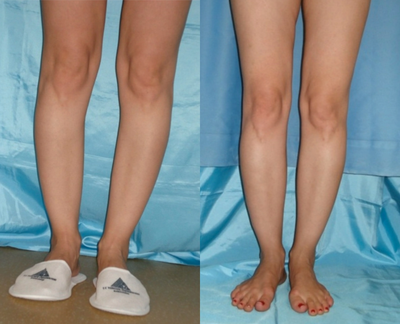 Lower Leg Contouiring - 	Significant asymmetry between legs. Calf implant with endoscopic technique and stem cell riched fat grafting is used to contour the lower legs. 