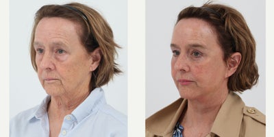 65-74 year old woman treated with Facelift, Neck Lift, Brow Lift, Eyelid Surgery, Facial Fat Transfer, CO2 Laser - 70 year old 3 months after a Facelift, Neck lift, brow lift, upper and lower bleph, fat transfer and co2 laser by Dr. Dilip D. Madnani.
