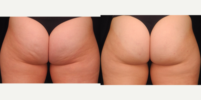 38 y/o - QWO - This is a 38 y/o female who came to us unhappy about the appearance of cellulite on her buttocks and posterior thighs. She underwent QWO, releasing 36 areas. Photos are pre-procedure and 5 months after.