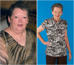 Female Gastric Bypass Patient Lost 124 lb - 
	This female patient lost 124 pounds in the year following her gastric bypass procedure.
