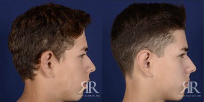 18-24 year old man treated with Ear Surgery - Ear Pinning Surgery
