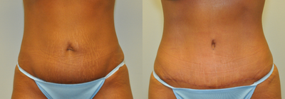 35-44 year old woman treated with Drainless Tummy Tuck - 40 year old female 9 months following a drainless abdominoplasty using a progressive tension closure technique.