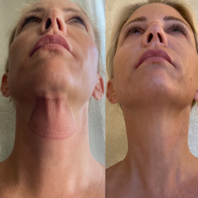 45-54 year old woman treated with Plasma Pen - Fibroblast skin tightening with plasma pen to treat lose skin under chin/mid neck.