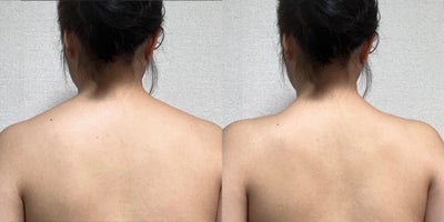 18-24 year old man treated with Lipodissolve - Fat-dissolving injections to contour the shoulder line