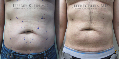 45-54 year old man treated with SculpSure - Abdomen and flanks
