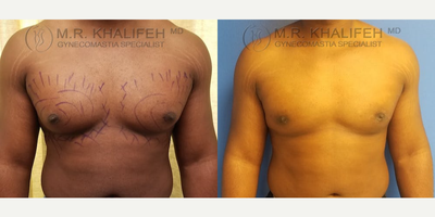 35-44 year old woman treated with Gynecomastia Surgery - In this case, we used no drains and only peripatellar incisions to take care of overdeveloped gland tissue in an otherwise large muscular athletic male.