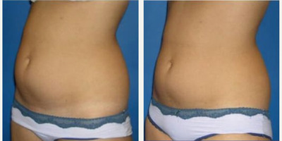 25-34 year old woman treated with JuVaShape - 5 treatments with Alma Lasers JuvaShape of the abdomen and lower flanks with ultrasound fat destruction and radiofrequency skin tightening.