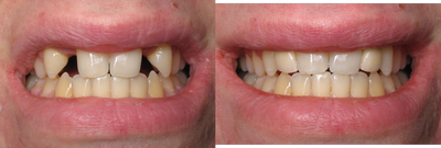 Dental Implants to Replace Missing Teeth - Missing natural upper lateral teeth replaced with no surgery. Mini Dental Implants and Crowns were placed in one short visit.