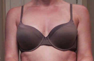 1.5 months post op 34B to 36D/34DDs- Downers Grove, IL - Review 