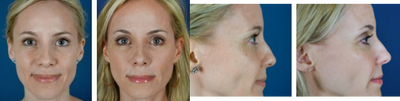 Female Patient Has Liquid Facelift - Female patient experiences facial rejuvenation with a liquid facelift.
