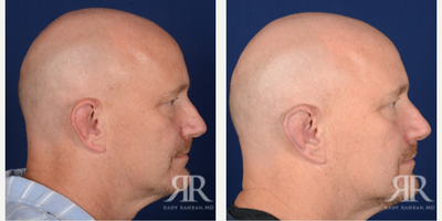 Man treated with Ear Surgery - Man treated with Ear Surgery