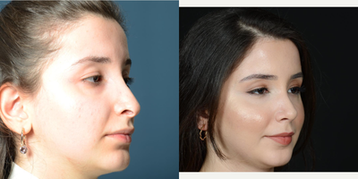 25-34 year old woman treated with Revision Rhinoplasty - revision rhinoplaty treatment for our patient