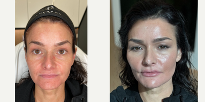 FILLER 'N THREADS COMBO - Our patient works in the industry so she would like to look her absolute best. She has noticed some signs of aging on her face, such as loss of volume in her mid face and prominent nasolabial folds. To correct this, we will be sculpting her face with filler as well as using PDO max threads- to give her a complete facial rejuvenation. We were able to  and sculpt her mid face leaving her cheeks contoured. We also gave her lips some natural looking plumpness, her chin that desired heart shaped look, and we didn't forget about defining her jaw for a snatched neck. All in all she cannot believe how amazing she looks and is in love with her results!WANT SOME FACIAL SCULPTING OR FACIAL THREADS? WHY NOT BOTH FOR THIS KILLER COMBO: