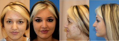 Natural Rhinoplasty  - 
	This rhinoplasty patient was unhappy with her wide nasal bone. Performed an open rhinoplasty to correct this problem.&nbsp;

