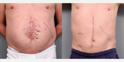Surgical Scar Revision - This patient had an open wound that was left to heal on its own 10 years ago. The result was the wide and cosmetically unpleasing scar shown on the left. What is not obvious is that he also had multiple large hernias on his belly that required advanced repair.

During the course of his abdominal wall reconstruction, we also decided to remove all of the old scar as well as rebuild his umbilicus.&nbsp;