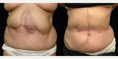 61 year old woman treated with Scar Revision - She needed an abdominal wall reconstruction after a major intra-abdominal catastrophe. She had a large wound that had been allowed to heal on its own over the course of several months. I decided that the best way to reconstruct her was to put the muscles of her tummy back where they belonged. In doing so, I was also able to remove the large scar on her tummy and reapproximate her skin back where it had originally come from. This also allowed me to put her belly button back where it belonged.